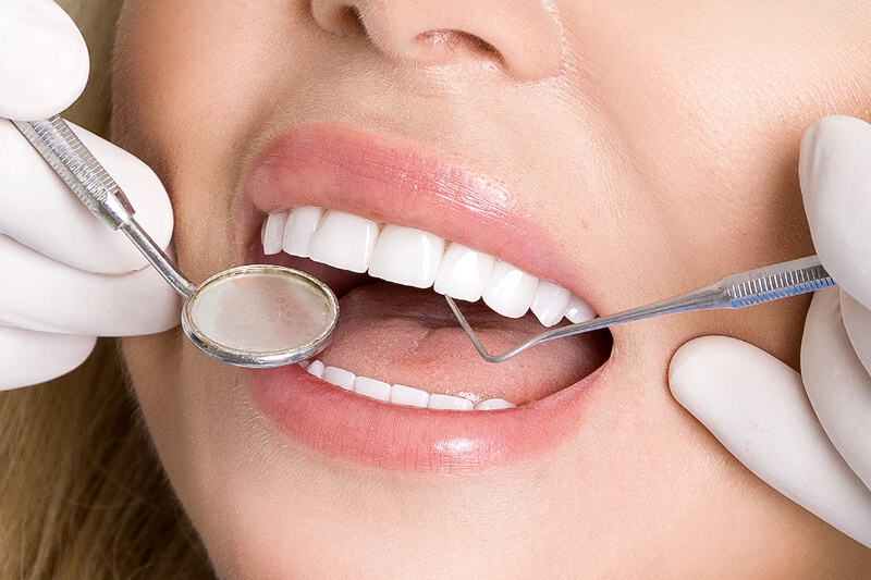 Ultra-thin porcelain veneers - Modern technology for a Hollywood smile