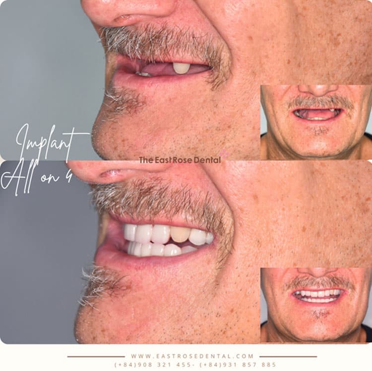 Results of tooth restoration at The East Rose Dental Clinic