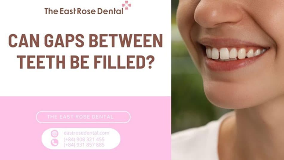 How much does it cost to get your gap teeth bonded?