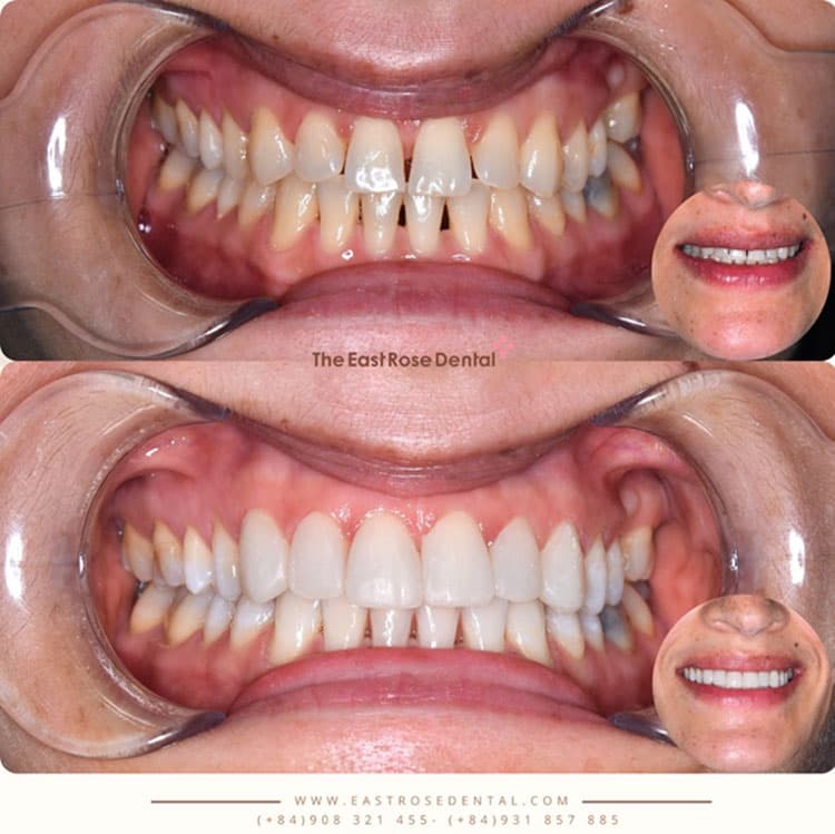 Composite fillings improve the condition of gapped teeth 