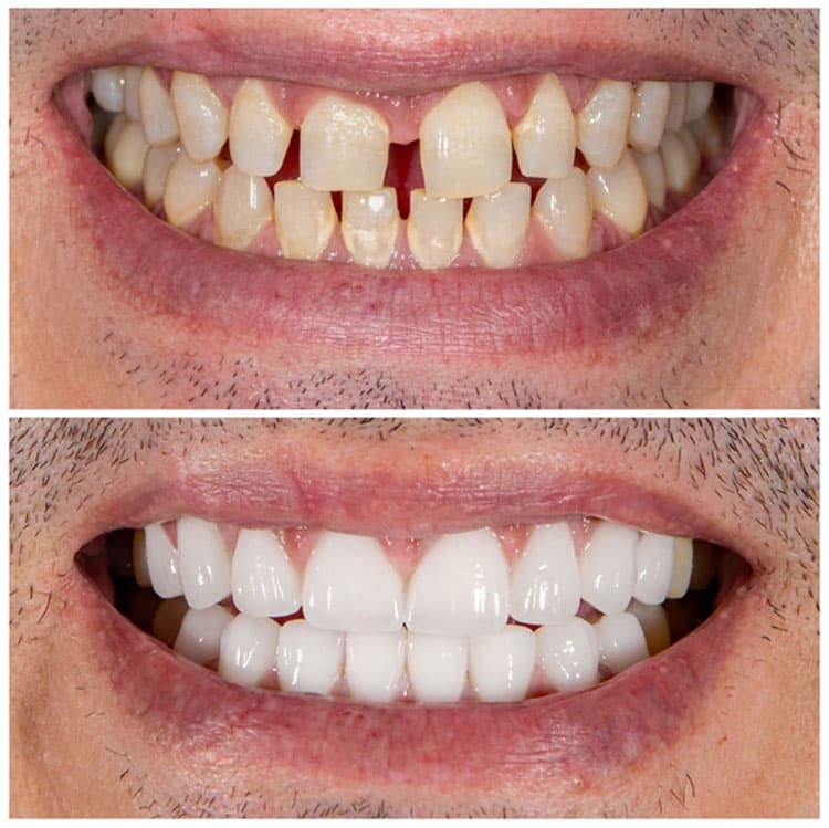 Veneer application results for improving gapped teeth at The East Rose Dental Clinic