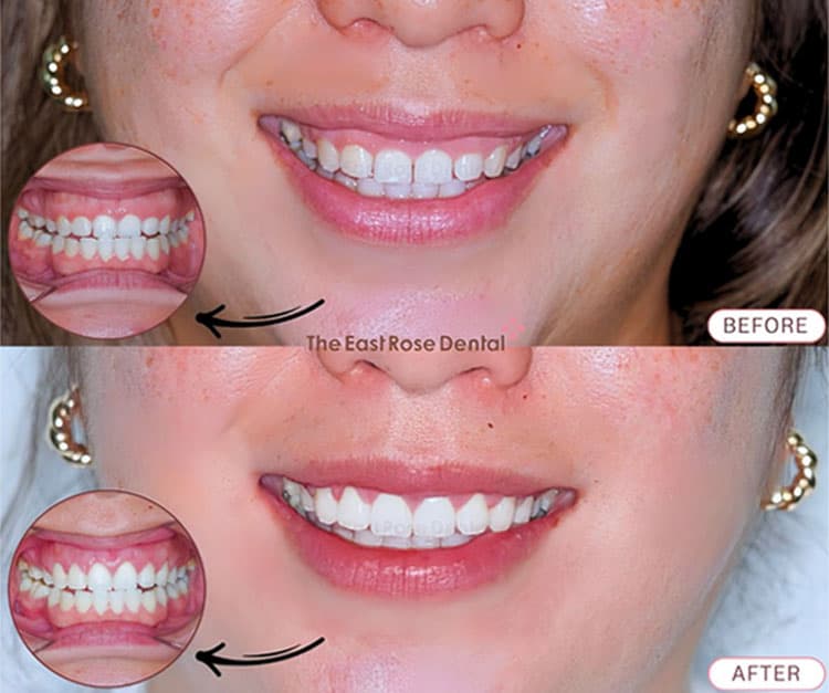 Results of Aesthetic Gum Surgery at The East Rose Dental Clinic