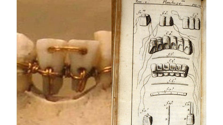 The braces method originated in the 18th century