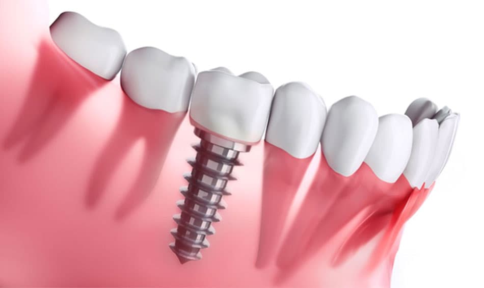 Single implant method to replace lost teeth