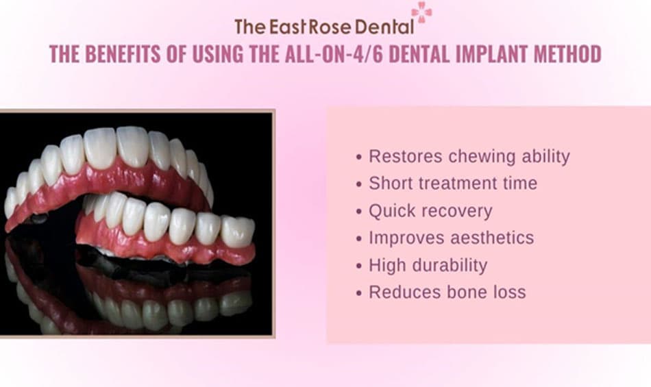 The All-on-4/6 implant method offers numerous exceptional benefits