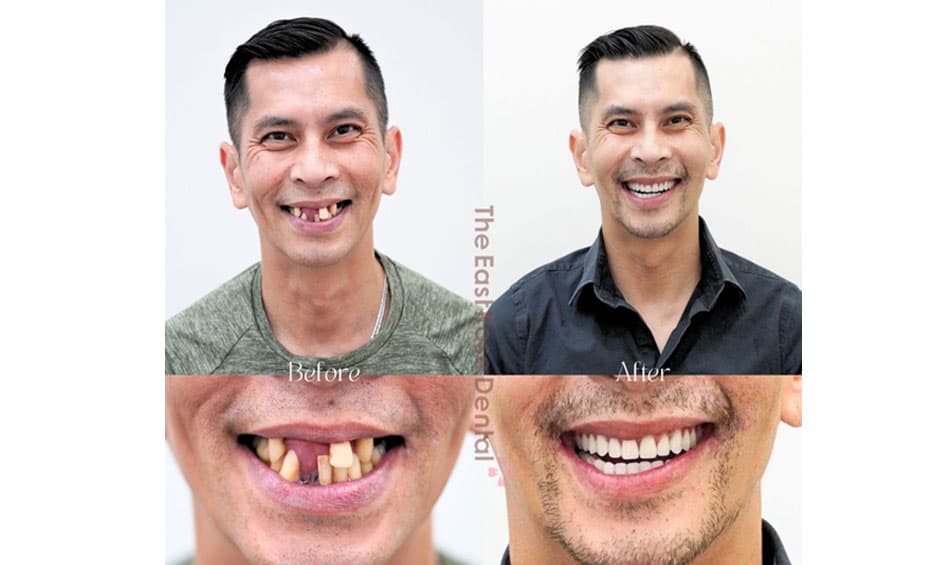 The aesthetic restoration results of All-on-4 at The East Rose Dental