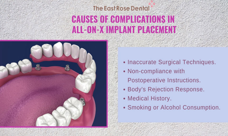 Causes of complications in All-On-X implant procedures