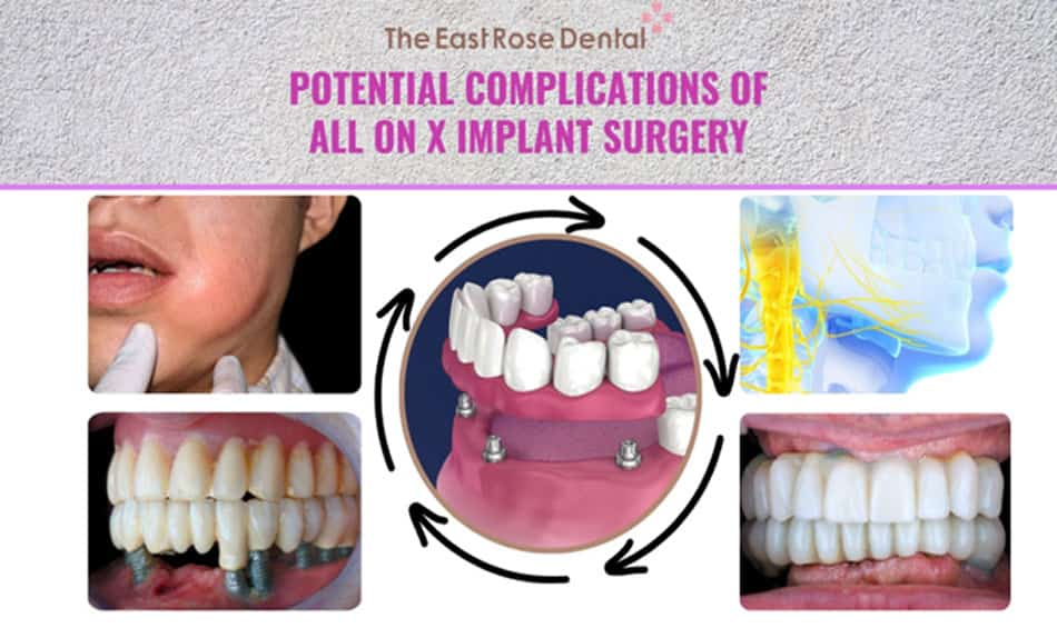 Common complications in All-On-X full arch implant procedures (illustration)