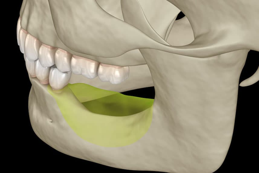 The truth about jaw bone loss? What is the solution?