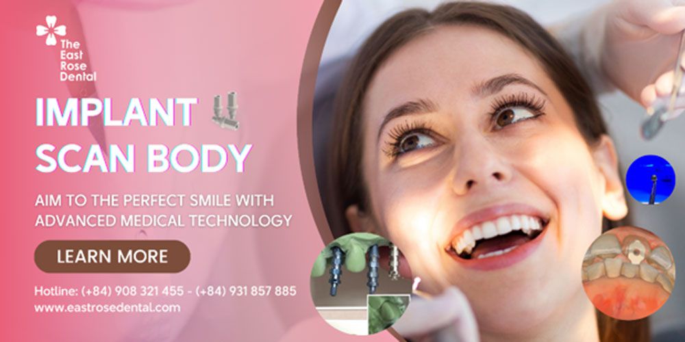 Implant Scan Body: Aim To The Perfect Smile With Advanced Medical Technology