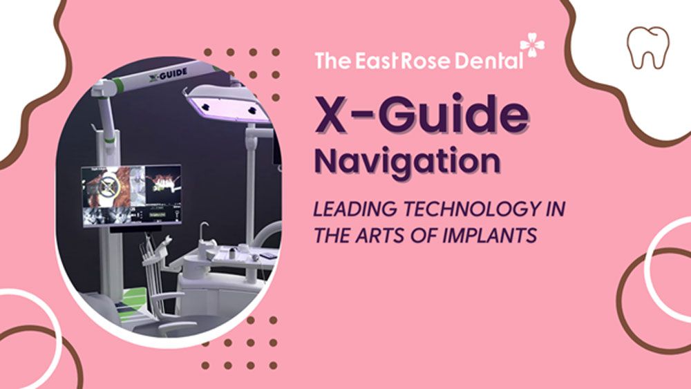 X-GUIDE - LEADING TECHNOLOGY IN THE ART OF IMPLANTS