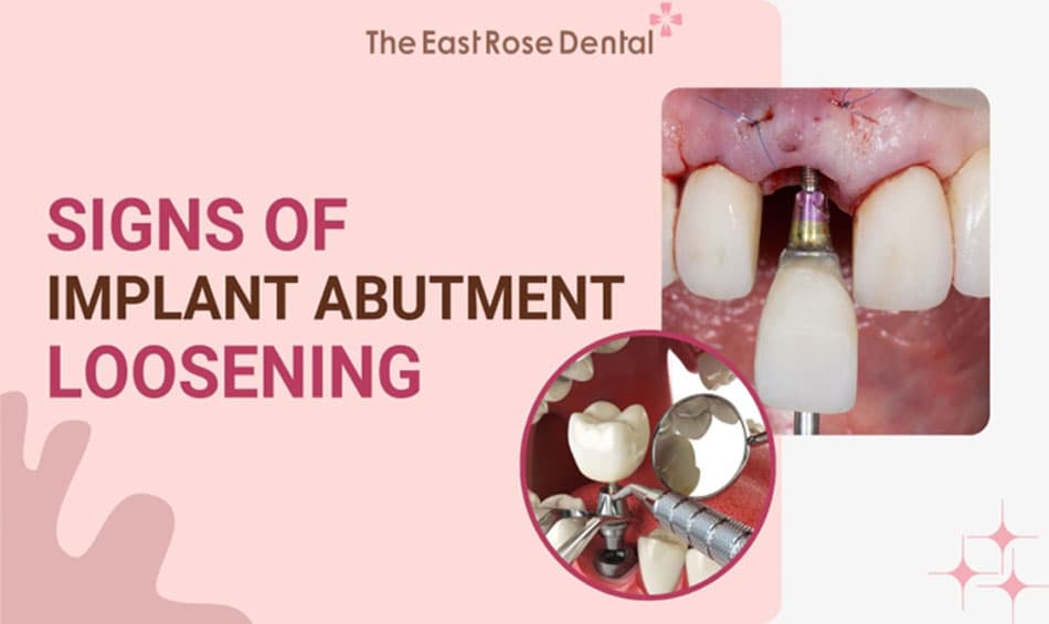 4 Signs of Implant Abutment Loosening - Causes and Solutions