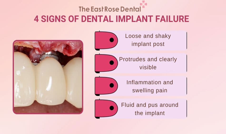 Signs of implant abutment loosening