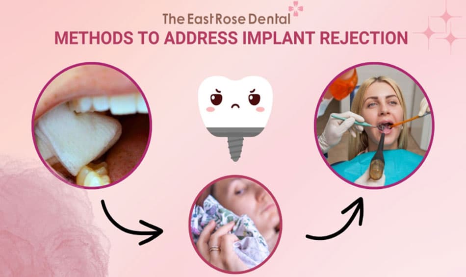 Steps to Address Implant Abutment Loosening