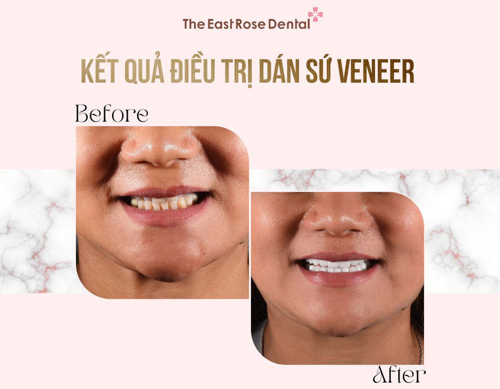 Case porcelain veneer at East Rose Dental Clinic