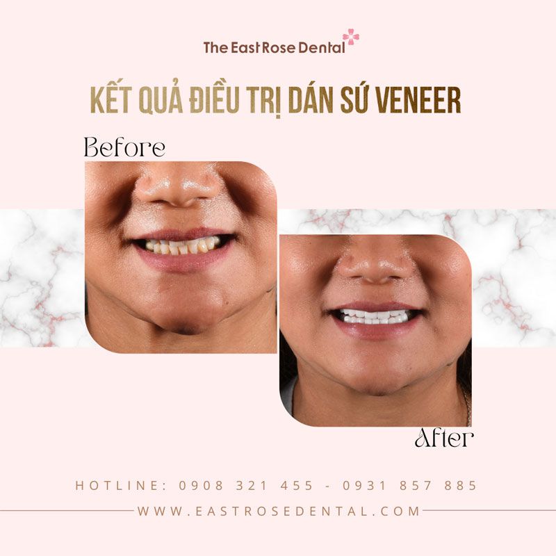 Veneer cases performed by The East Rose Dental Clinic