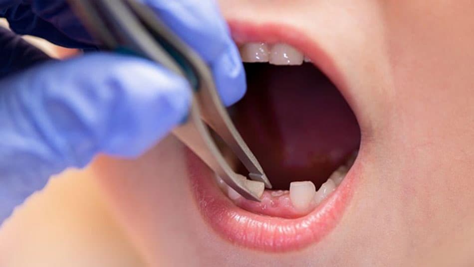 Caring for baby teeth in children is extremely important