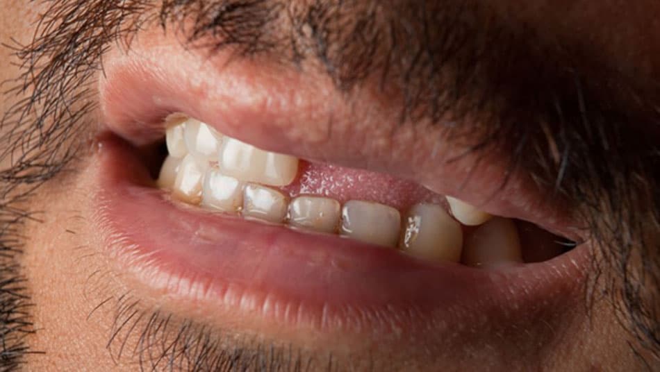 Prolonged stress can lead to tooth loss