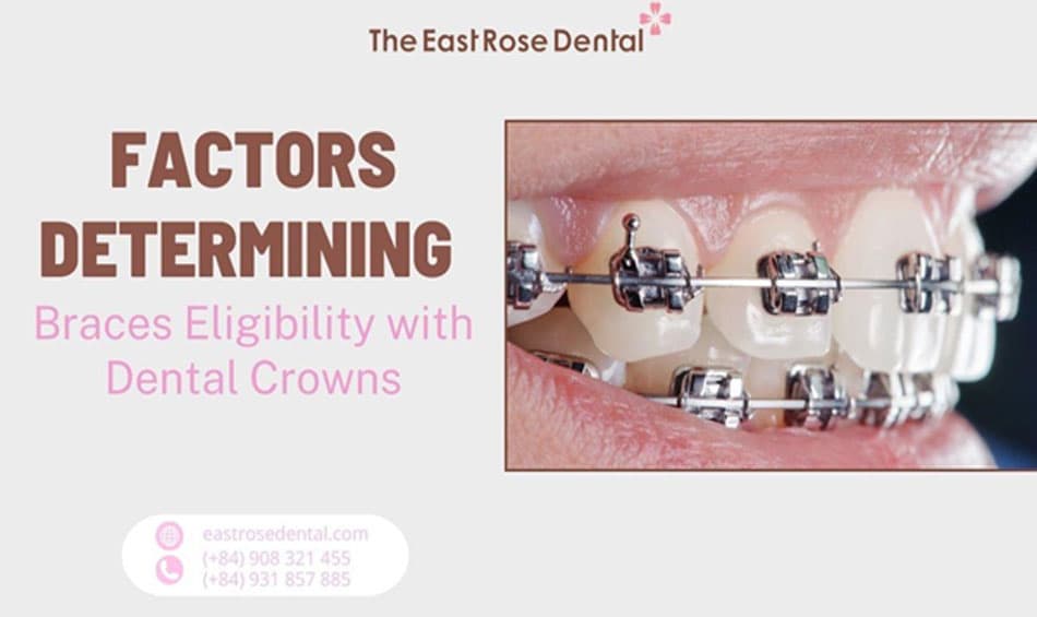 Factors Affecting the Feasibility of Braces After Porcelain Crowning