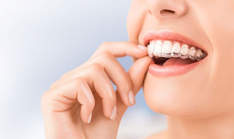 Invisalign Clear Aligners