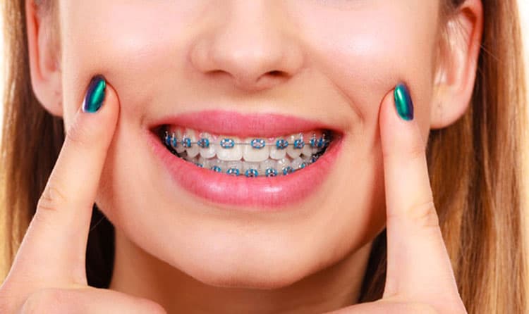 Metal Braces for Porcelain-Crowned Teeth