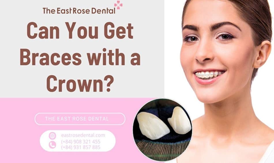 Answering the question, Is it possible to get braces after having porcelain crowns?