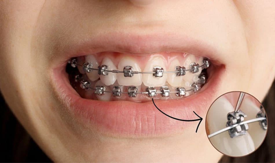 Self-Ligating Braces Method