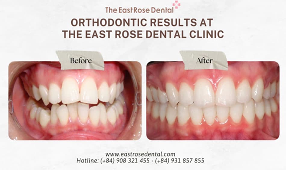 Benefits of early orthodontic treatment