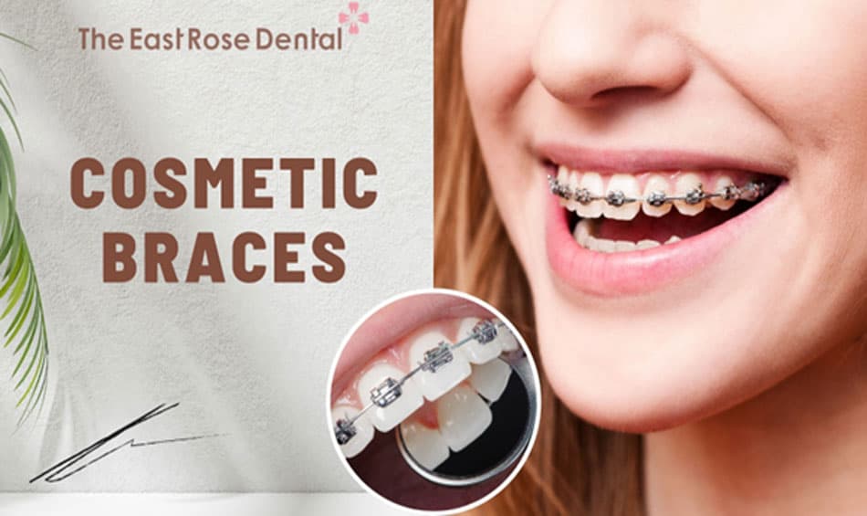 The benefits of cosmetic braces and common types of braces are discussed.