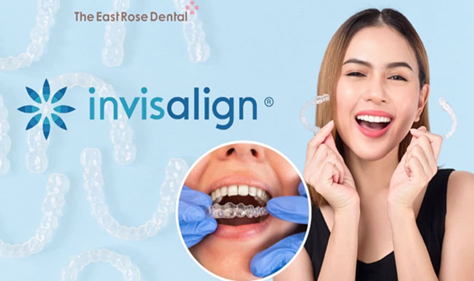 Invisalign Clear Aligners