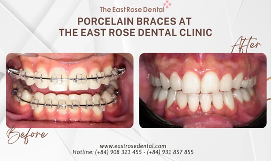 Results of ceramic bracket braces at The East Rose Dental Clinic