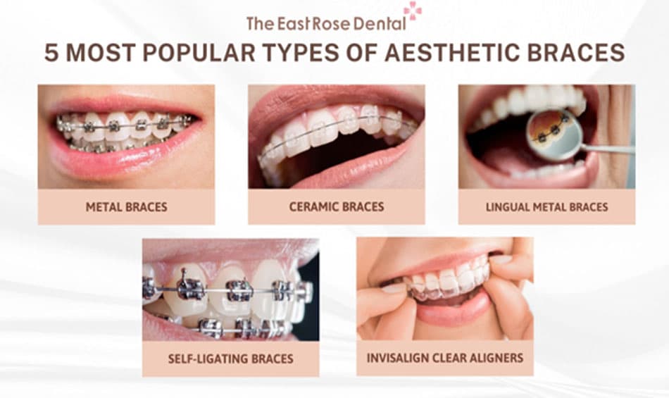 The most common types of braces