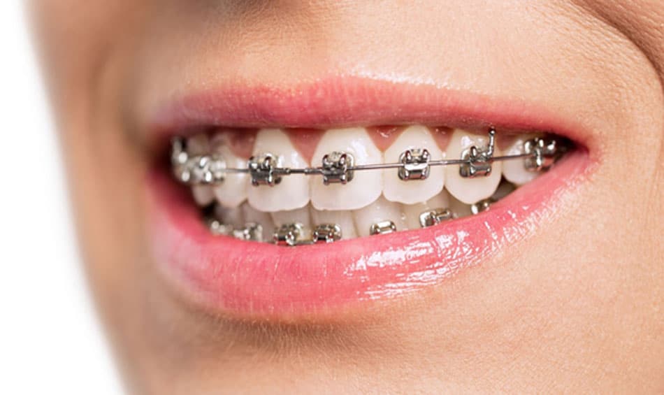 Advantages and disadvantages of Metal Braces