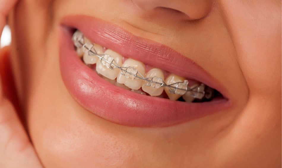 Ceramic Braces vs. other types of Braces