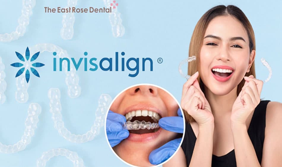 Clear Aligners (Invisalign) are the most advanced orthodontic method currently available