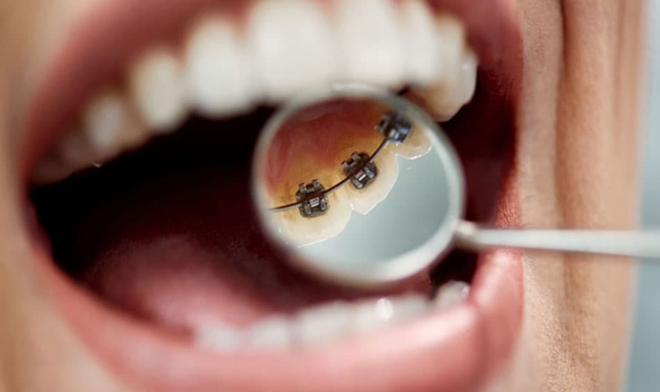 Lingual braces provide a highly aesthetic result