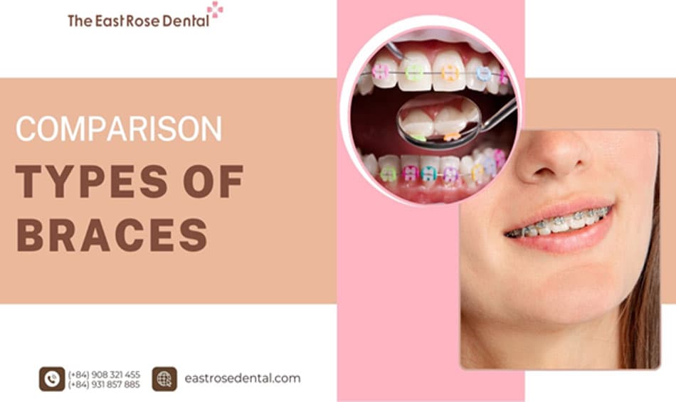 A comparison of the most popular types of braces.