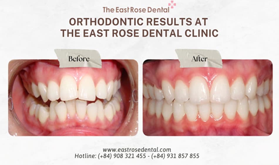 Results of Orthodontic Treatment at East Rose Dental Clinic 