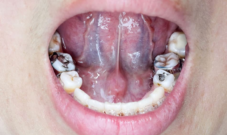 Braces can hinder effective oral hygiene.