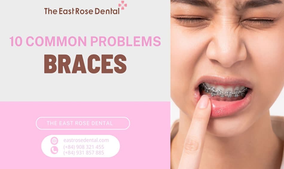 10 common issues with braces and their effective solutions