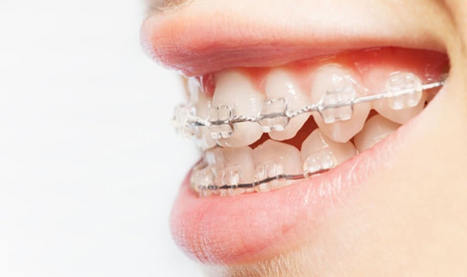 Temporary bite misalignment during braces treatment