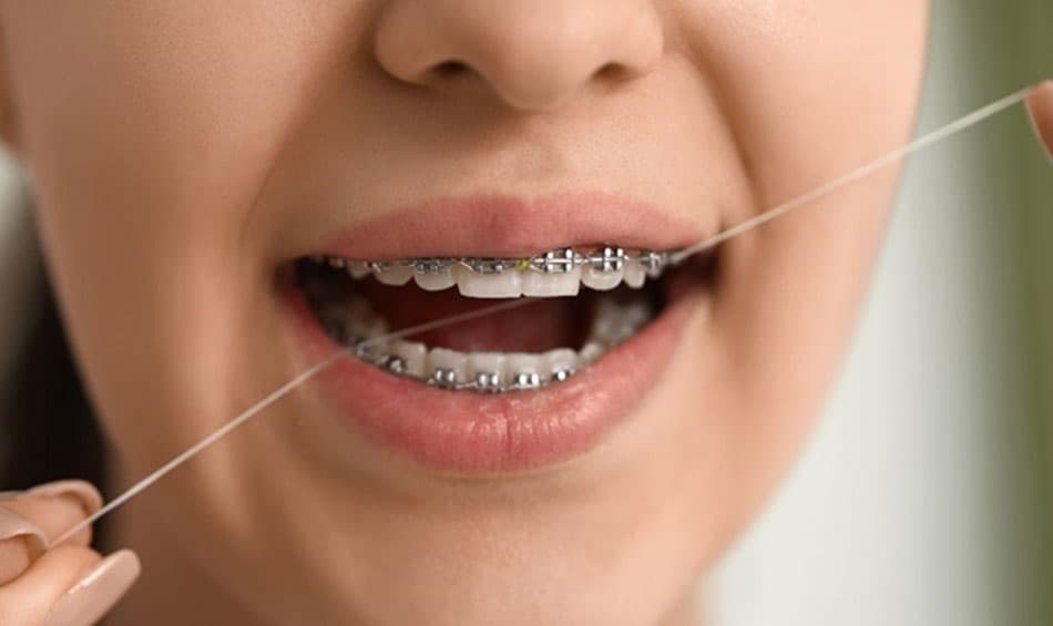 Dental floss is an essential step in the cleaning process