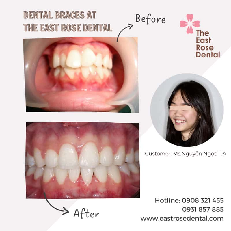 orthodontic braces case at The East Rose Dental Clinic