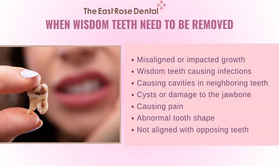 Cases requiring wisdom teeth removal 