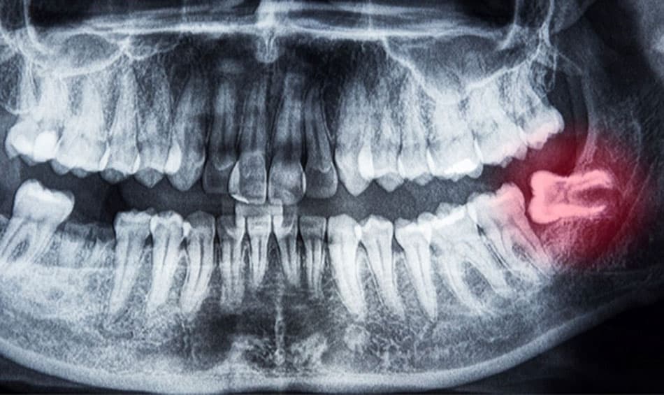 Wisdom teeth cause misalignment and affect adjacent teeth