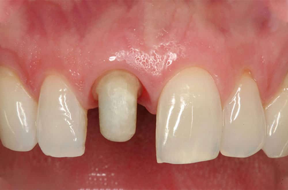 All Technical Information About Tooth Grinding