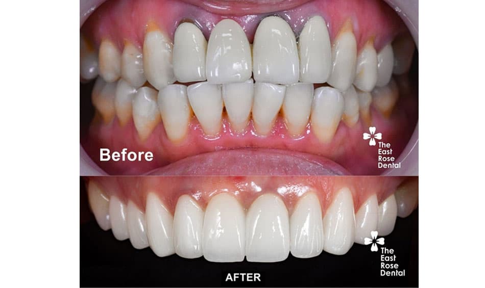 Results of dental crown restoration at East Rose Dental