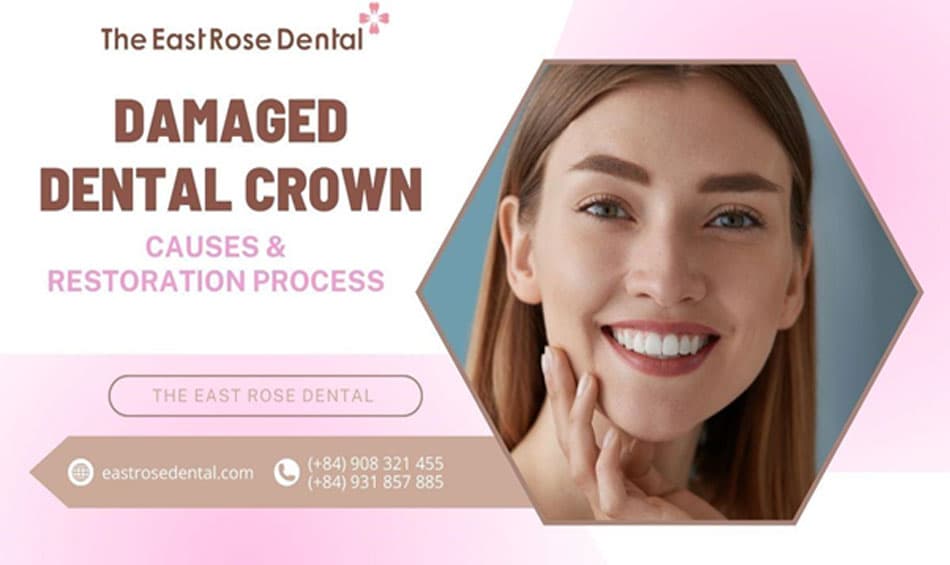 Procedures for Restoring Chipped, Broken, or Cracked Dental Crowns