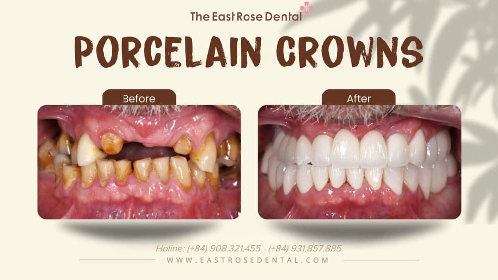 Case Porcelain Crown at East Rose Dental 