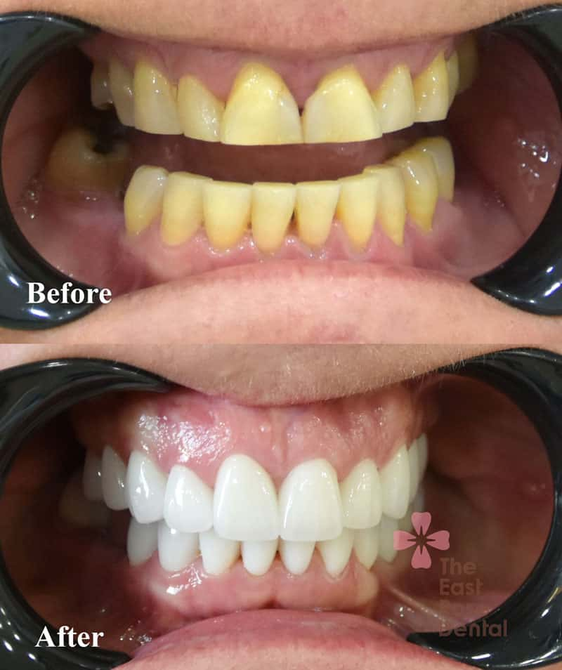 Case Porcelain Crown at East Rose Dental 